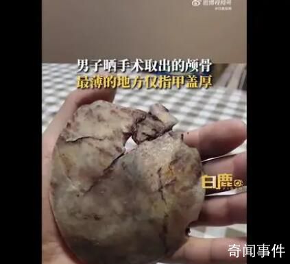 男子術后曬顱骨碎片:最薄處像指甲