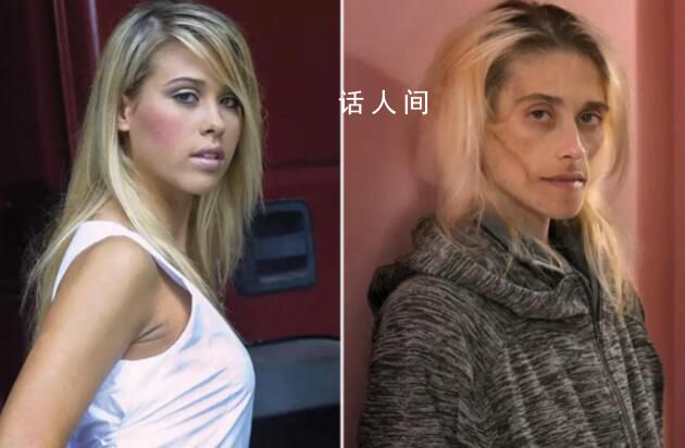 35歲模特患厭食癥去世時(shí)僅23公斤 牙齒也掉光了