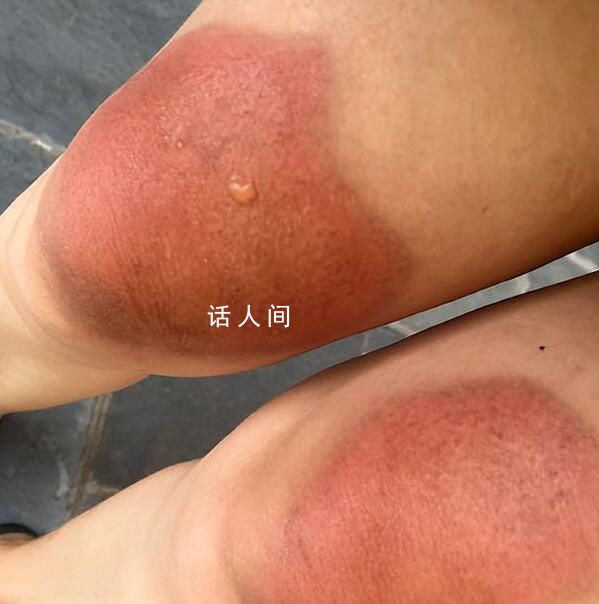 女子云南穿破洞褲7小時腿被曬傷 經醫生診斷為二級燙傷