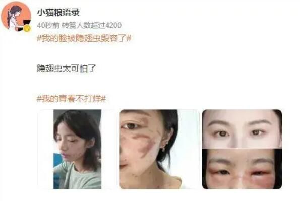 我的臉被隱翅蟲毀容了 不少網友曬出同款傷疤