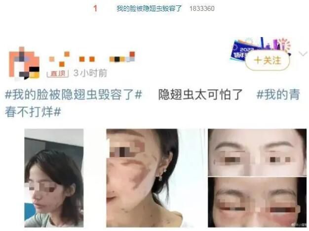 隱翅蟲的毒液堪比硫酸 隱翅蟲是什么來頭?