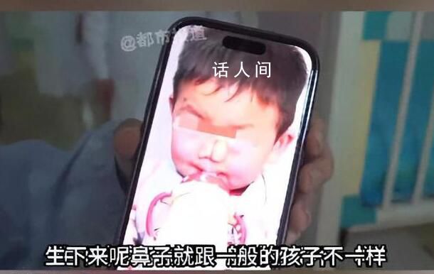 3歲男孩患象鼻病全球僅34例 且只在非洲國家發現