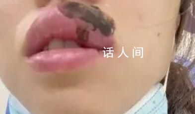 女子睡覺被蜈蚣咬醒 嘴腫成“香腸”