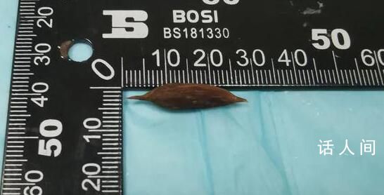 男子吃粽子誤吞棗核致小腸穿孔 運氣確實差了點