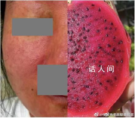 杭州女子養(yǎng)倉鼠臉爛成火龍果 整張臉紅得發(fā)紫