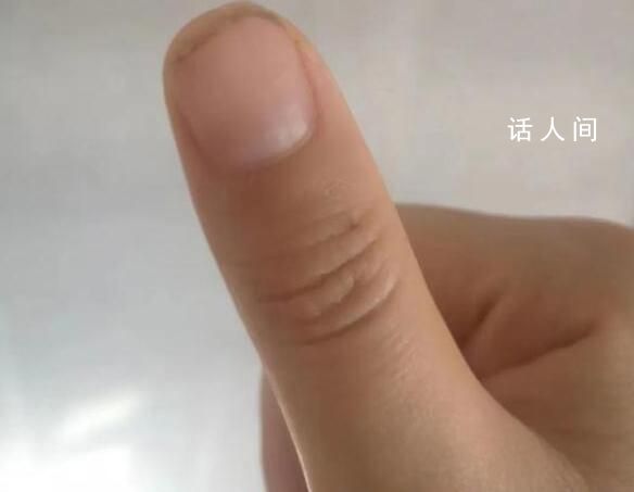 荔枝季致廣東人拇指成黑色 廣東人又實現了荔枝自由