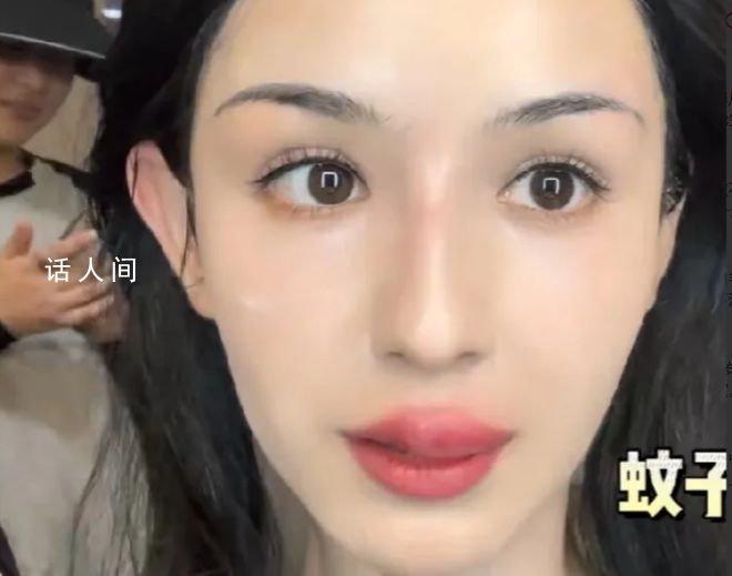 哈妮克孜被蚊子咬成香腸嘴 這一意外引起了廣大網友的共鳴和關注