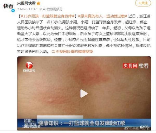 13歲男孩一打籃球就全身發癢 停止運動數小時后癥狀自動消失