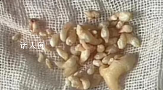 拔掉57顆牙是什么體驗 引發(fā)熱議