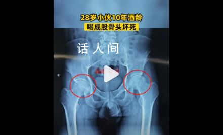 28歲小伙酒齡10年致股骨頭壞死 引發人們對酒精危害性的深思