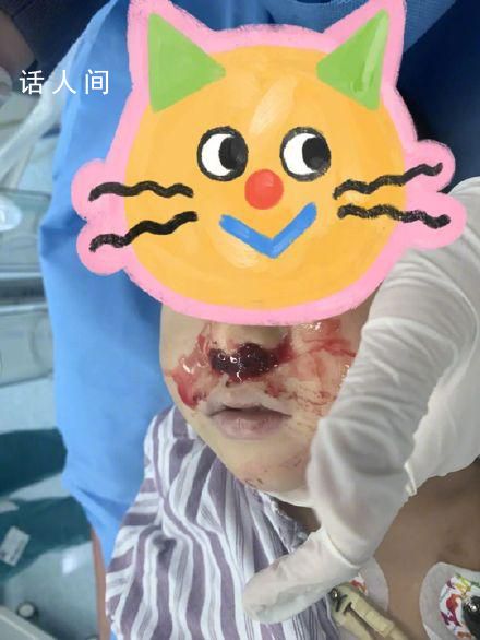 奶奶向3歲男童鼻腔塞頭發止血 送到醫院的時候已經出現休克現象