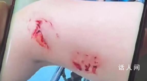 游客被不明魚類咬傷 救援人員發聲