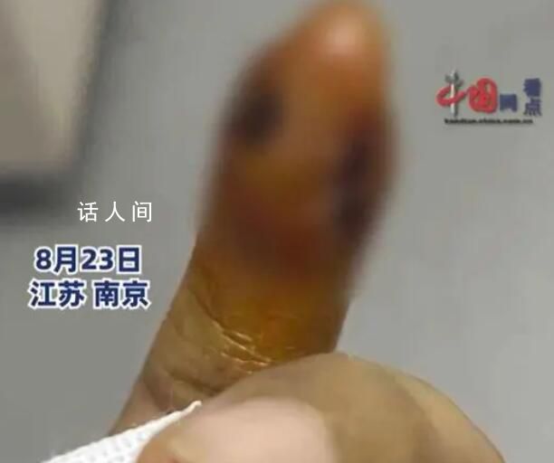 女子拔倒刺致骨髓炎要刮骨手術 處理不當會有截肢風險