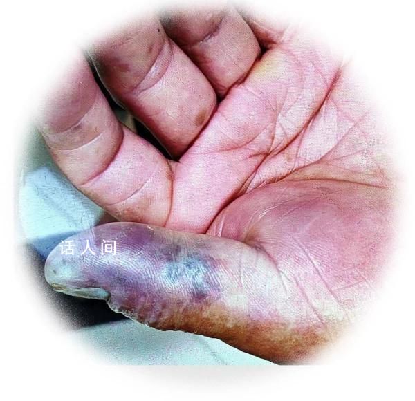 男子洗小龍蝦被刺傷 3天后離世