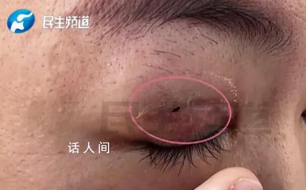 女子雙眼皮修復后 閉上眼能看到外面