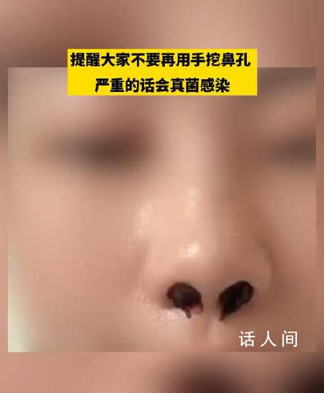 女生稱因愛摳鼻子致鼻內長多團真菌 目前手術后從蝶竇里取出10多個真菌團