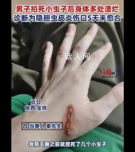 男子拍死隱翅蟲多處潰爛5天未愈 目前傷口仍未愈合