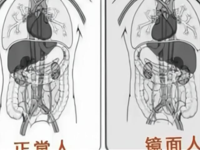 女子就醫發現五臟六腑全長反 這種病例在全球的發生率僅為百萬分之一