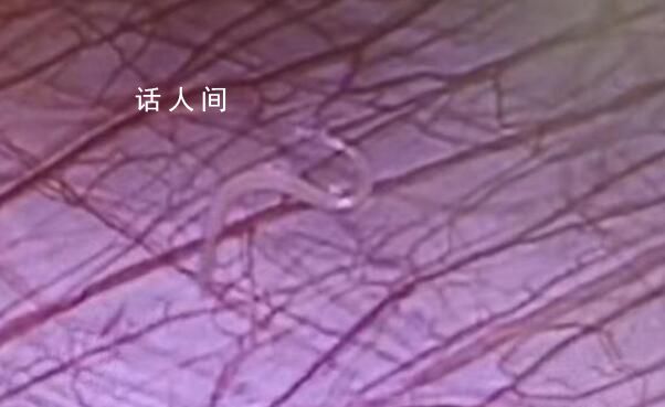 女孩外地求醫(yī) 切開闌尾有蟲子游出