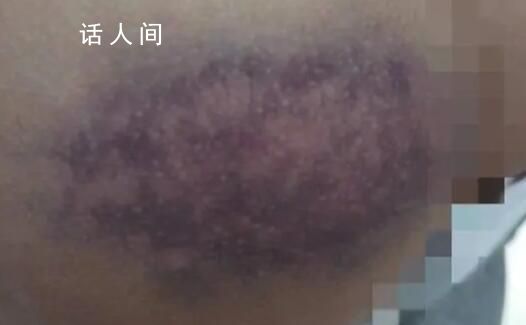 官方調(diào)查學(xué)生屁股被老師打成黑紫色 引發(fā)家長(zhǎng)的不滿