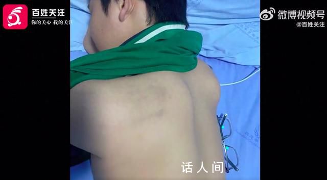 家長稱13歲兒子被紀(jì)律委員打骨折 身體多處軟組織損傷