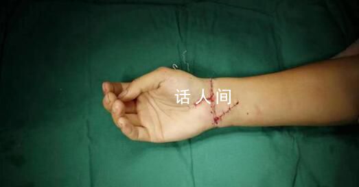 29歲小伙手腕被切斷醫生通宵縫合 通宵手術只為保住小伙右手