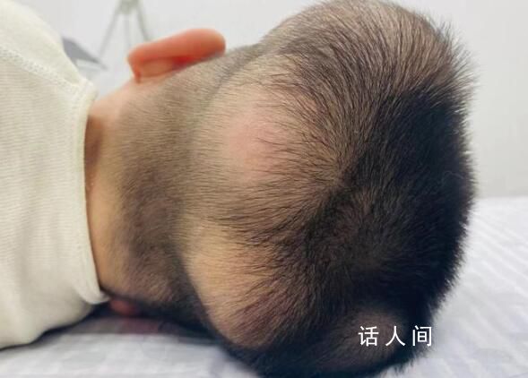 5歲男童患“超級罕見病” 頭部及身體多處長腫瘤