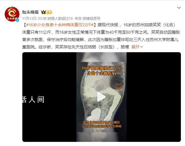 16歲少女患十余種病體重22斤 無法進食不停嘔吐