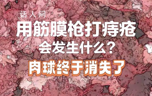 筋膜槍可以治痔瘡?可能造成血管破裂