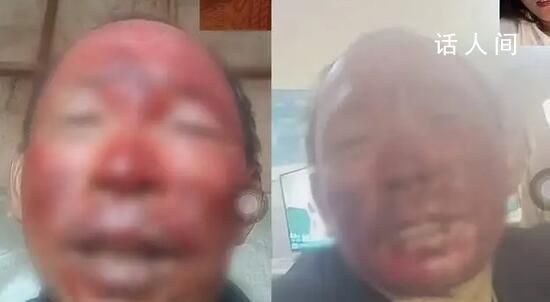 女婿去世女兒住院 男子燒傷不舍就醫(yī)