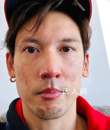 港星關(guān)智斌面部手部二級燒傷 好在及時就醫(yī)目前已經(jīng)全部康復(fù)