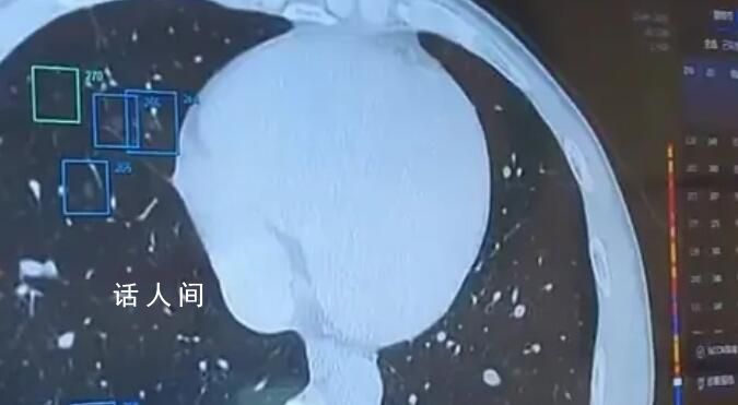 37歲男子肺部發現557個結節 診斷最終傾向早期肺惡性腫瘤