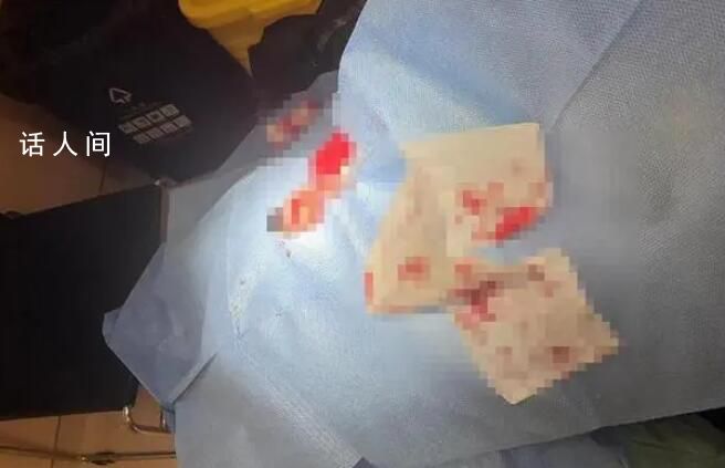 小伙理發(fā)時耳朵被剪縫六針 雙方?jīng)Q定等拆線后據(jù)傷情再協(xié)商