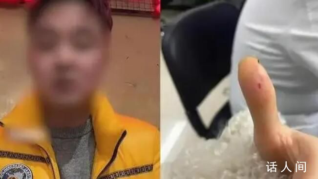 顧客被筷子毛刺扎手治療花1.7萬 醫(yī)院回應(yīng):未接到任何有關(guān)方異議