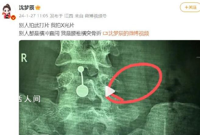沈夢辰腰椎骨頭斷裂 第四腰椎左側橫突骨折骨頭無法復位
