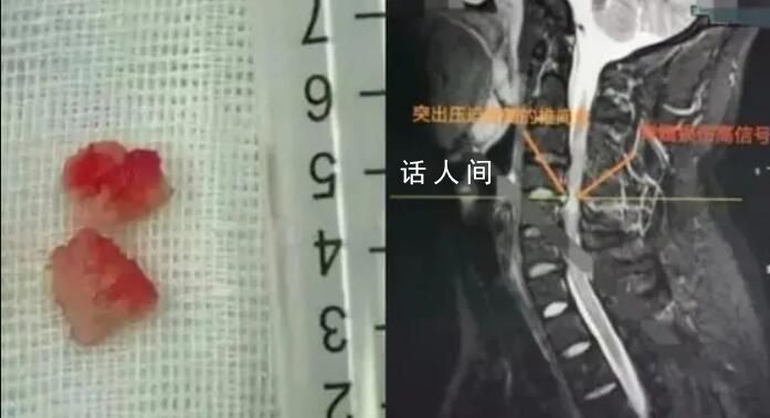 男子在私人工作室按摩險全身癱瘓 兩塊椎間盤組織掉入椎管中