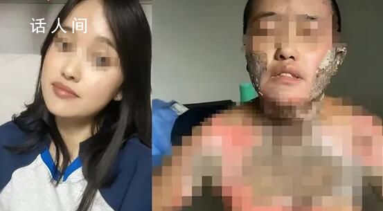 官方通報(bào)女子被丈夫潑酒點(diǎn)火燒傷 已組建聯(lián)合工作組主動(dòng)介入