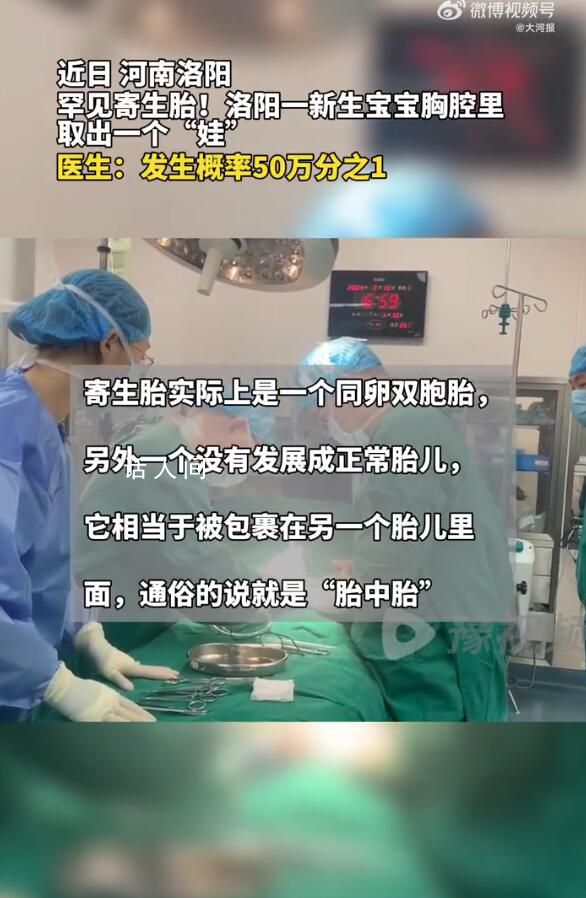 河南醫生成功分離罕見胎中胎 手術后的男嬰身體狀況良好