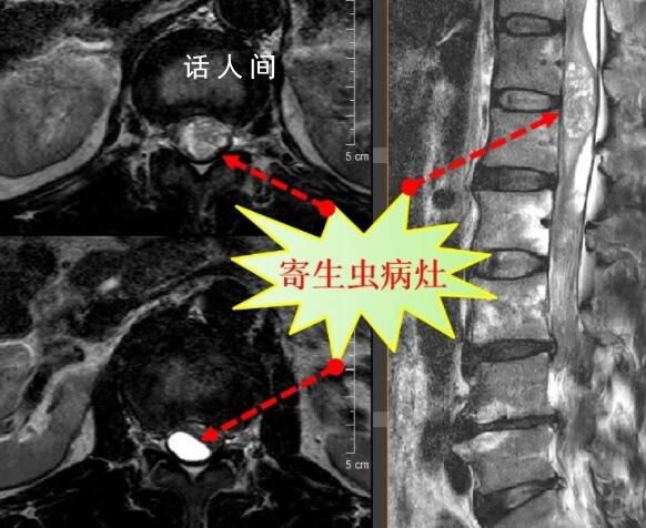 男子吞蛇膽喝蛇藥15年后發(fā)病 生吃蛇染寄生蟲