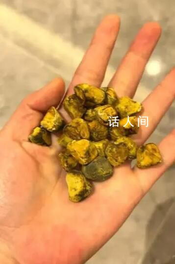 女生取24顆膽結(jié)石沒(méi)事盤(pán)著玩 21顆膽結(jié)石留在了手中